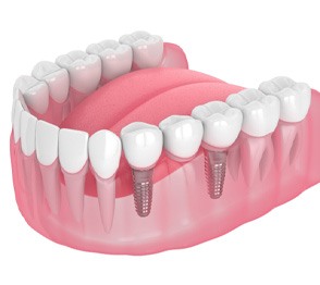Illustration of bridge attached to dental implants in Austin, TX